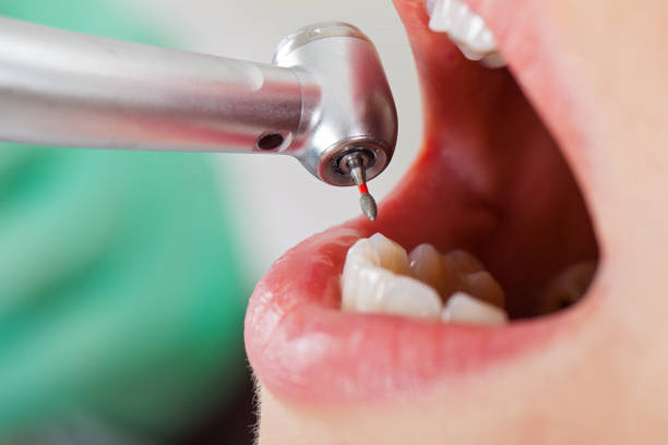 Best Emergency Tooth Extraction in New Hope, OR